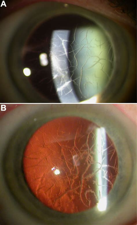 間質角膜失養症 Stromal Corneal Dystrophy Swordman 的部落格 Udn部落格