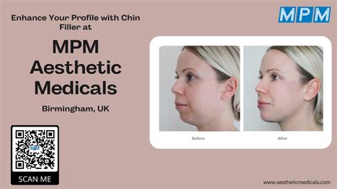 Enhance Your Profile With Chin Filler At MPM Aesthetic Medicals