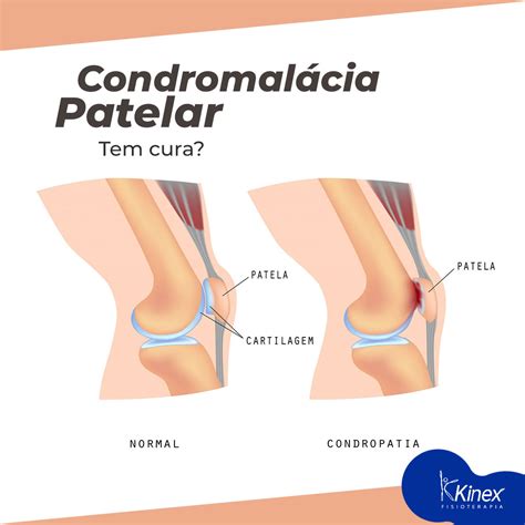 Condromalácia Patelar tem cura Kinex Fisioterapia