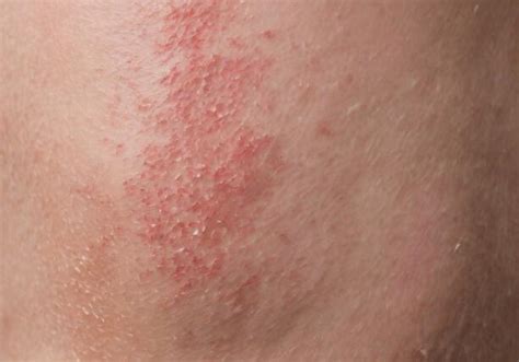 How To Identify Different Types Of Skin Rashes