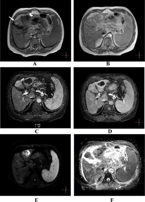 Complete Ablation Of Hcc With Newly Detected Hcc Nodule A Axial T1