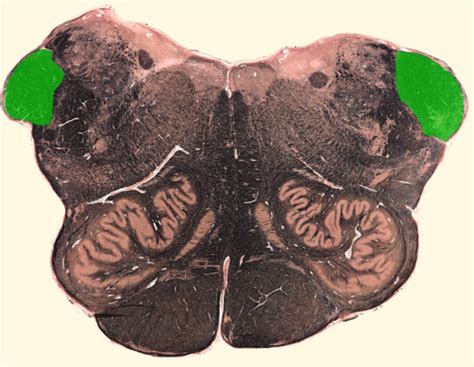 Brainstem Internal Structures Cross Sections Of Rostral Open