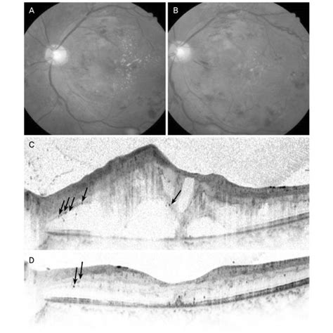 A 27 Year Old Male Presented With Diabetic Macular Edema Injected Download Scientific Diagram