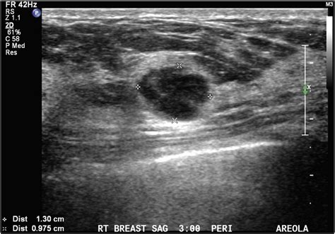 Ultrasound Of Right Breast Showing A Heterogeneous Hypoechoic Nodule