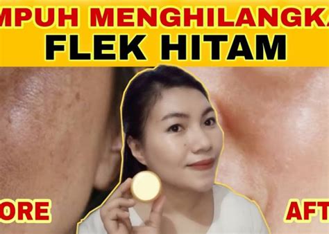 3 Krim Penghilang Flek Hitam Terbaik Yang Efektif Bikin Wajah Mulus