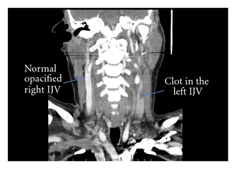 Normal Neck Ct Scan