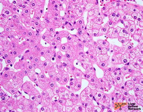 Liver Biopsy Interpretation Special Stains Aasld