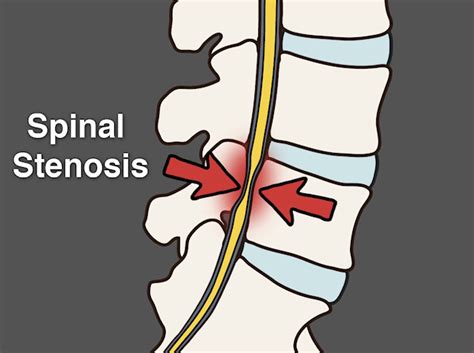 Spinal Stenosis Surgery | Risks| Cost | Recovery | Treatment Sutured