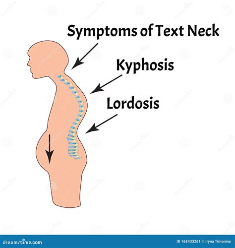 The Position Of The Spine With Lordosis. Spinal Curvature, Kyphosis ...