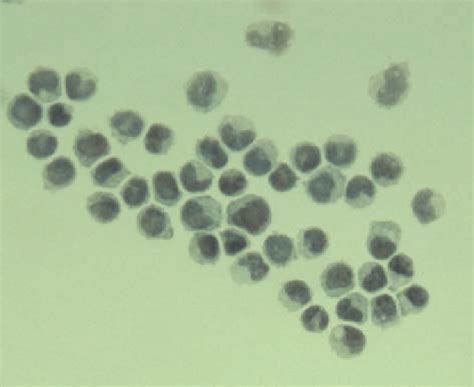 Cerebrospinal Fluid Cytology Consistent With Atypical Promyelocytes And Download Scientific