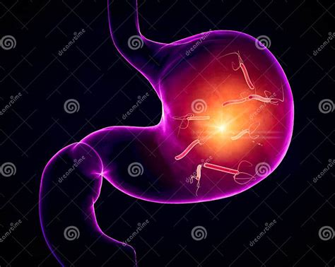 Helicobacter Pylori is a Gram-negative, Flagellated, Helical Bacterium ... 