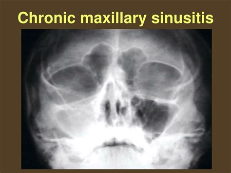 Maxillary Sinusitis Antibiotics