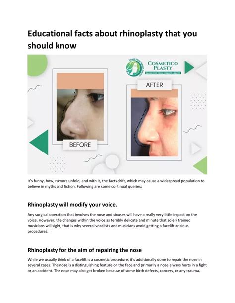 Ppt Educational Facts About Rhinoplasty That You Should Know