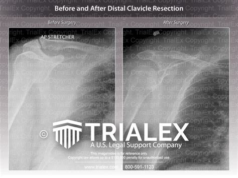 Before and After Distal Clavicle Resection - TrialExhibits Inc.