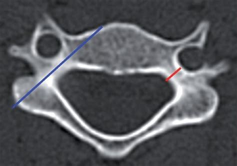 Technique Of Measuring The Pedicle Width And The Axis Length In The