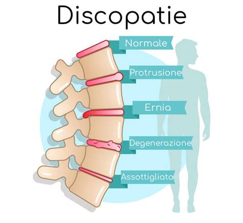 Ernia Del Disco Sintomi Esercizi Cure Ed Intervento