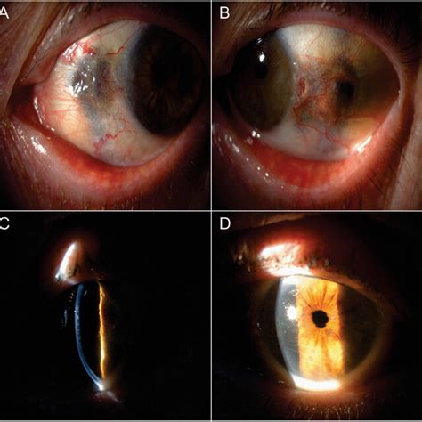 Descemets Membrane Folds On Anterior Segment Optical Coherence