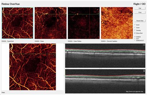 Optovue Angiovue Oct And Octa Imaging System Ophthalmicmart