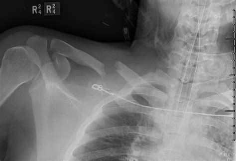 Deficits Following Nonoperative Treatment Of Displaced Midshaft