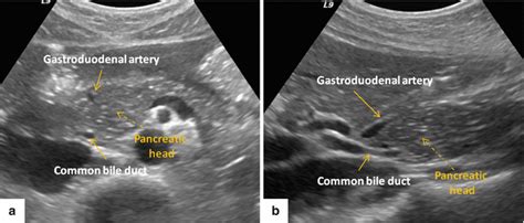 Imaging Of The Pancreas Radiology Key