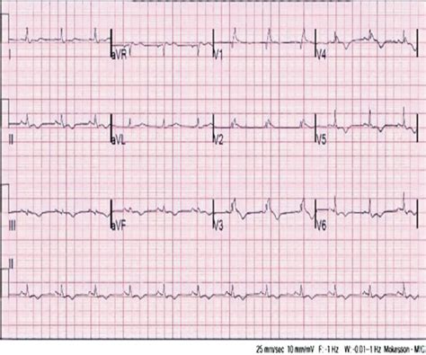 A 12 Lead Ekg On The Day Of Acute Pulmonary Embolism Diagnosis