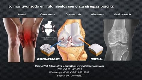 El dolor y la limitación por artrosis es algo del pasado con la