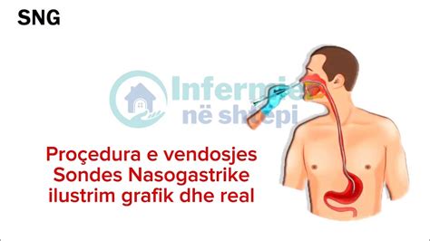 Sonda Nasogastrike Vendosja Sondes Nasogastrike Infermierneshtepi