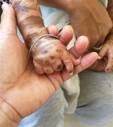 Baby With Harlequin Ichthyosis Causes Symptoms And Treatment