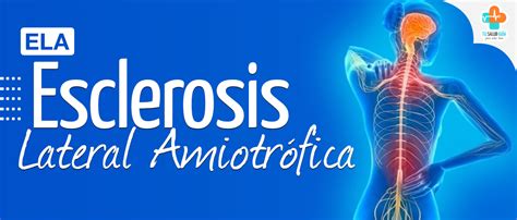 Esclerosis Lateral Amiotr Fica Ela Directorio M Dico Tu Salud Gu A