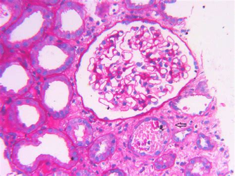 Renal Biopsy Showing Normal Glomerulus Dilated Proximal Tubules With