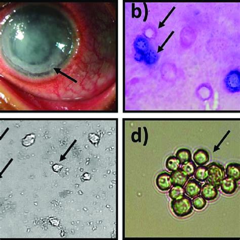 Pdf Clinical Presentations Genotypic Diversity And Phylogenetic Analysis Of Acanthamoeba