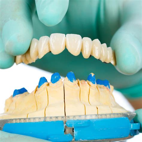 Restoring Smiles Exploring The Art Of Dental Crowns And Bridges