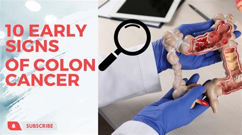 10 Early Warning Signs Of Colon Cancer Youtube