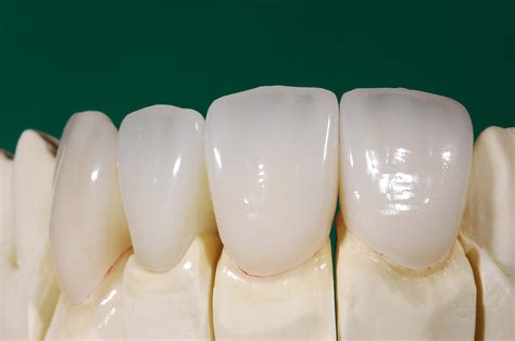 Ips Emax Crown And Bridge Dr Bharat Katarmal Dental And Implant Clinic