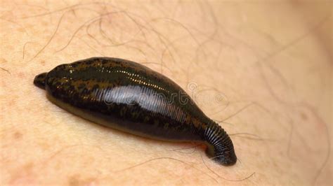 Medical Leech On The Human Body Drink Blood Treatment With Leeches