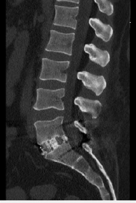 Sagittal Ct Lumbar Spine Download Scientific Diagram