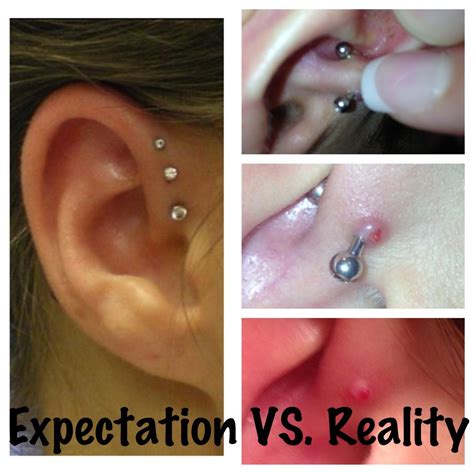 Forward Helix Piercing Infection