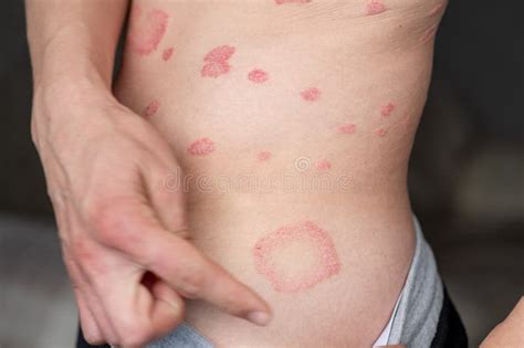 Psoriasis Vulgaris Skin Patches Are Typically Red Itchy And Scaly