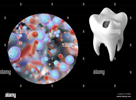 La Caries Dental Equipo Ilustración De Un Diente Con Una Cavidad Y Una Vista Cercana De La