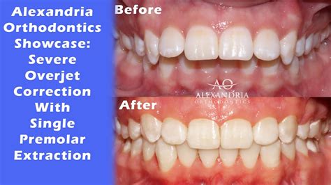 Alexandria Orthodontics Showcase ⁠severe Overjet Correction With