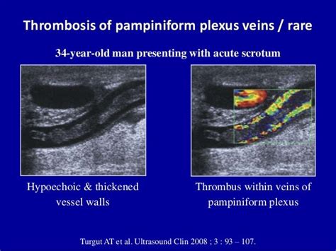 Doppler Ultrasound Of Acute Scrotum