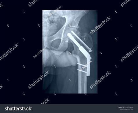 Film X Ray Hip Radiograph Showing Stock Photo 1430934566 | Shutterstock