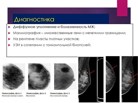 Заболевания молочной железы - online presentation