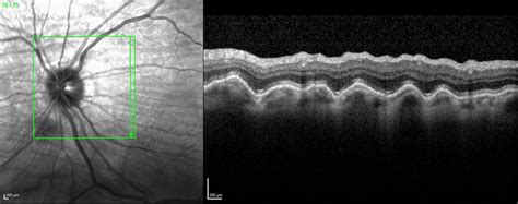 Posterior Segment Differential Diagnoses 23 Westmead Eye Manual