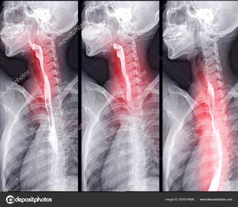 Barium Swallow Study Test Diagnose Barretts Tract Exam Gerd Ulcers