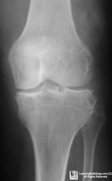 LearningRadiology - Pigmented Villonodular Synovitis, PVNS