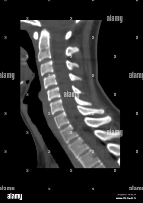 Normal Cervical Spine