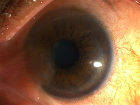 Basics Of Limbal Stem Cell Deficiency For The Postgraduates