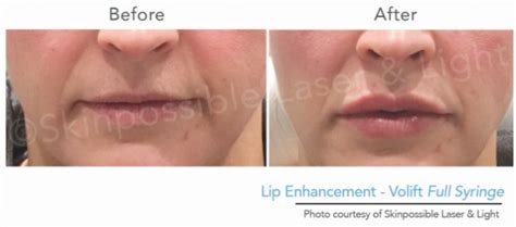 Lip Injections Dermapure Chaparral Formerly Skinpossible