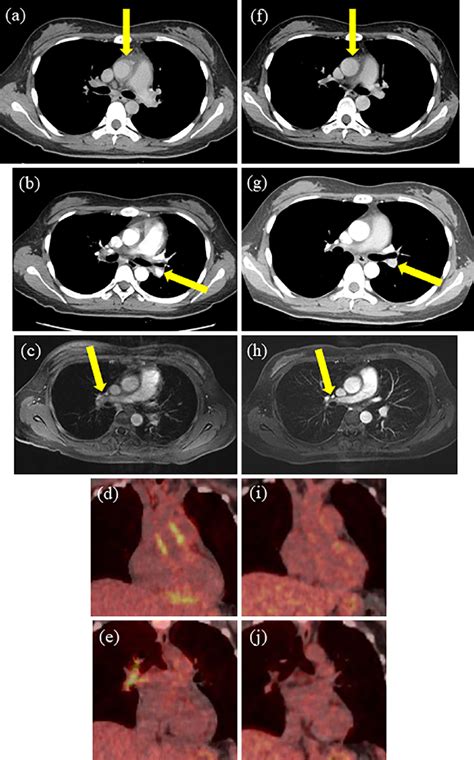 Figure1 Imaging Findings Of Case 1 A B Contrast Enhanced Computed